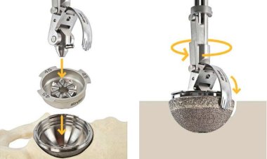 EZout – Acetabular Cup Removal System