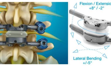 Machine Vision Technology – for Spine Surgery