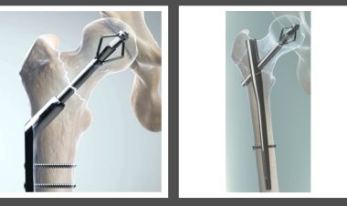 X-Bolt – Hip Fixation System