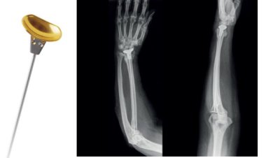 Prosthelast – Distal Radius Hemiarthroplasty Prosthesis