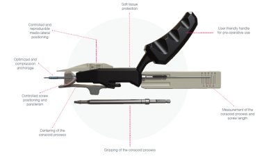 HyLa (Hybrid Latarjet) – a Mini-Open/Arthroscopy Combo System