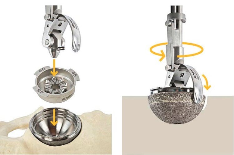 EZout - Acetabular Cup Removal System