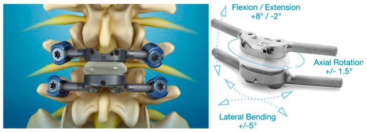 Machine Vision Technology - for Spine Surgery