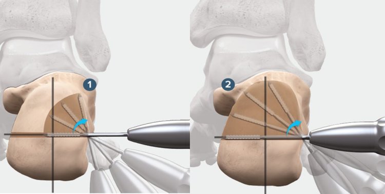 MIMCO - Minimally Invasive Medialising Calcaneal Osteotomy