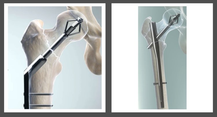 X-Bolt - Hip Fixation System