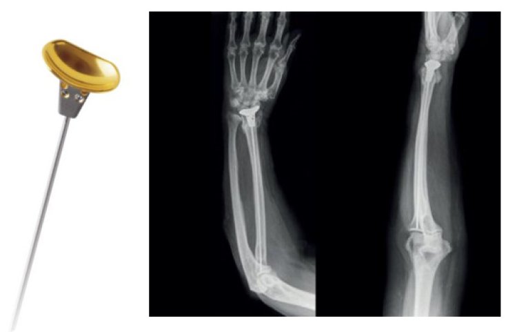 Prosthelast - Distal Radius Hemiarthroplasty Prosthesis